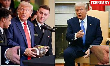 Trump’s Bruised Hand Pops Up to Wish ‘Lips’ Leavitt a Happy Birthday